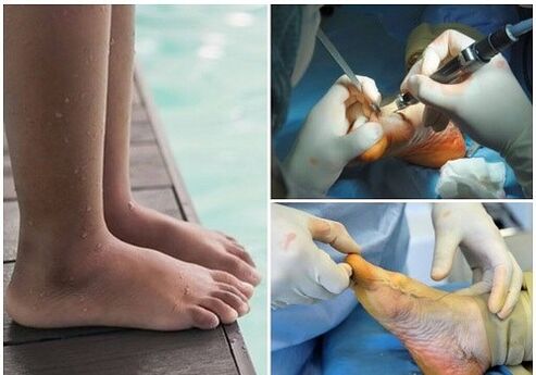 Small invasive surgical treatment