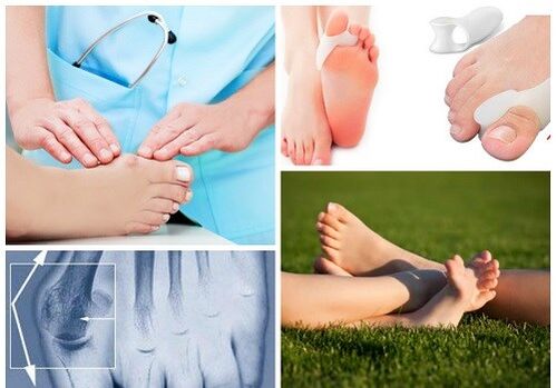 Treatment of the Valgus deformation